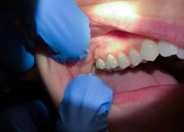 Best Emergency Broken Tooth Repair in Watford City, ND